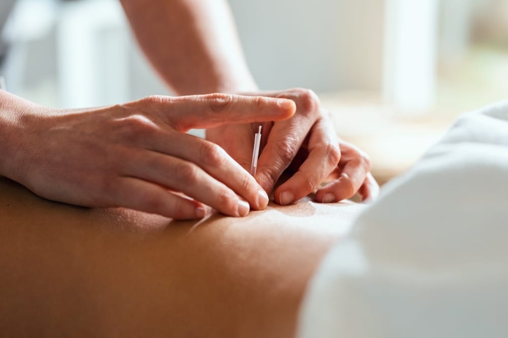 A close-up of a practitioner inserting an acupuncture needle into a person's back during a treatment session - Chiropractor Kennesaw GA A close-up of a practitioner inserting an acupuncture needle into a person's back during a treatment session - Chiropractor Kennesaw GA